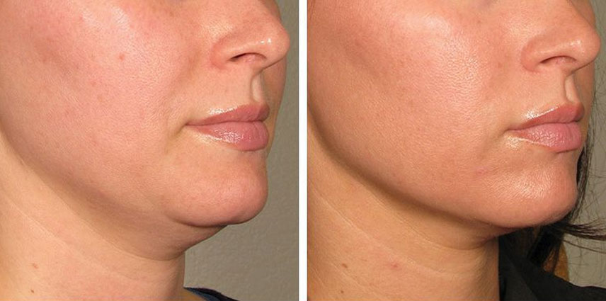 HIFU RF Tightening Anti-Aging Therapy by Dr. Pinky Mehta in Kandivali