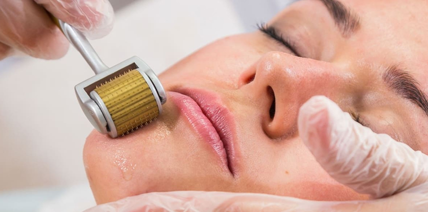 Dermaroller Treatment in Kandivali East and West - Dr. Pinky Mehta